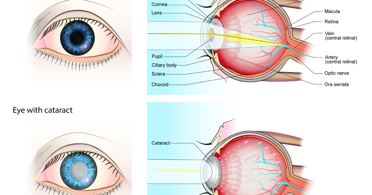 How Early Cataract Detection Supports Better Long-Term Vision